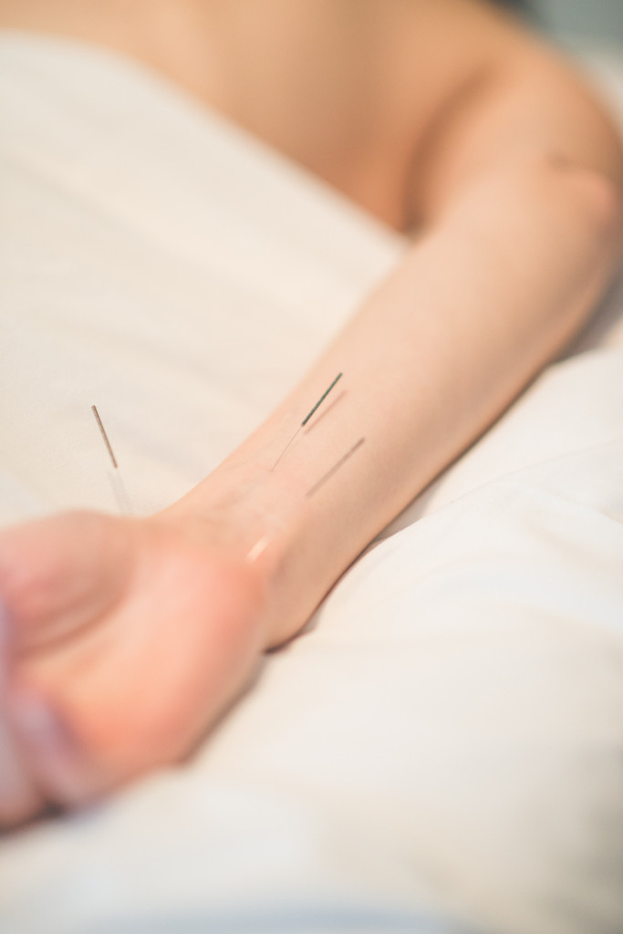 Close up of acupuncture needles in the wrist.
